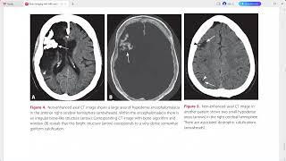 BRAIN IMAGING WITH MRI AND CT [upl. by Zelikow203]