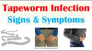 Tapeworm Infection Signs amp Symptoms Nutrient Deficiencies amp Complications [upl. by Irim]