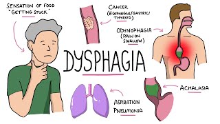 Dysphagia  Oropharyngeal amp Esophageal Dysphagia CausesDifferential Diagnosis Signs Treatment [upl. by Noryahs]