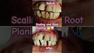 Oral Hygiene Scaling and Root planing conventional periodontal therapybdshorts dental smile [upl. by Uht]