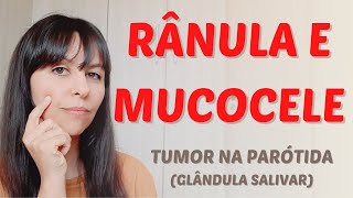 O que é mucocele e rânula Tumor na Parótida glândula salivar [upl. by Manning]