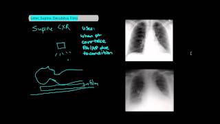 Types of Chest XRays part 2  Lateral Supine Decubitus UndergroundMed [upl. by Eisac]