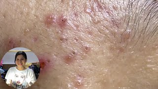 Acne Treatment Huong Da Nang The video has been lost for a long time Remove Blackheads [upl. by Aseneg294]