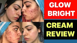 melasma treatment cream in hindi  acne removal cream  pimples ka cream [upl. by Cressy118]