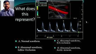 Secrets of Carotid Ultrasound [upl. by Ann-Marie809]