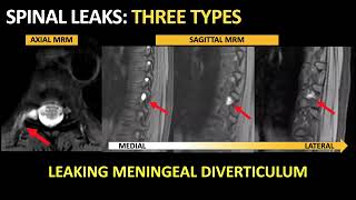 Algorithmic Multimodality Approach to Diagnosis and Treatment of Spinal CSF Leak [upl. by Kreegar]