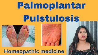 Palmoplantar Pulstulosis treatment  Palmoplantar Pulstulosis symptomscauses amp homeopathic medicine [upl. by Ora95]