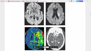 NEURO RADIOLOGY CASES LECTURE [upl. by Atalie304]