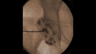 IntraArticular Hip Injection Using Anatomic Surface Landmarks [upl. by Eveline744]