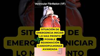 fibrilación ventricular medicina corazon arritmias emergency medico latidodelcorazón heart [upl. by Jemmie]