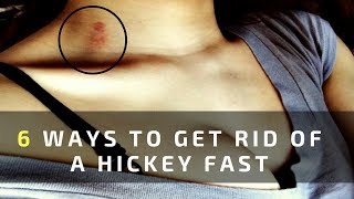 6 Ways to Get Rid of a Hickey Fast and Easy Overnight [upl. by Loella637]