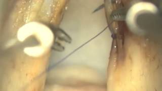 ruptrued cyst advanced flapmp4 [upl. by Akeenahs]