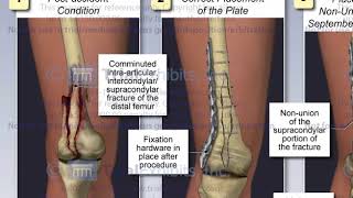 Right Distal Femur Fracture with Surgical Fixation [upl. by Nasho]