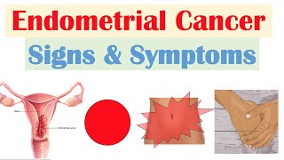 Endometrial Cancer Signs amp Symptoms amp Why They Occur [upl. by Kilk115]