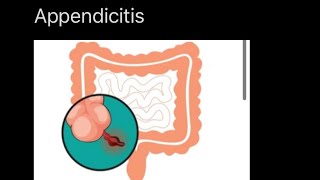 Apendicitis nursing care [upl. by Ricoriki]