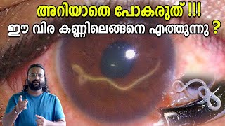 നമ്മുടെ കണ്ണിന് പണി തരുന്ന പാരസൈറ്റുകൾ Eye Parasites eye worms [upl. by Jessi]