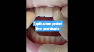 Applicazione protesi dentale fissa provvisoria [upl. by Eikciv892]