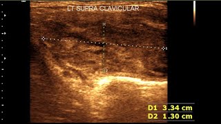 Supraclavicular lymphadenopathy  Cervical lymph node anatomy  Sonographic Appearance variation [upl. by Drarig430]