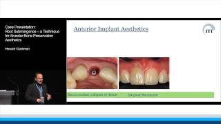 Case Presentation Root Submergence for Alveolar Bone Preservation  Howard Gluckman [upl. by Enifesoj468]