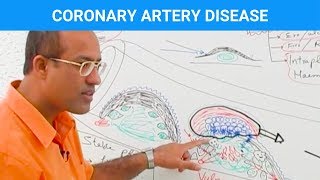 Coronary Artery Disease  Ischemic Heart Disease  Angina🫀 [upl. by Gypsy]