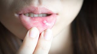 Mouth Ulcer Treatment urdu hindi Irfan Azeem YouTubeShorts [upl. by Iel873]