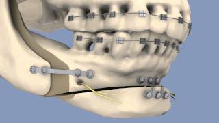 BSSO amp Osseous Genioplasty [upl. by Vivica]