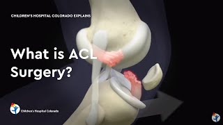 What is ACL Surgery [upl. by Tunk]