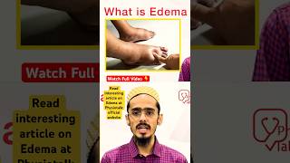 Edema क्या होता है  इसके Types क्या होते है  edema swelling shortsfeed [upl. by Wilhelm506]