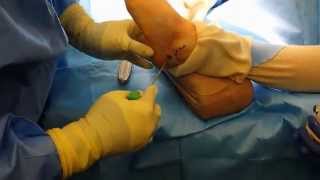 Bone graft small harvesting technique from calcaneus with bone marrow aspiration needle [upl. by Sarina474]