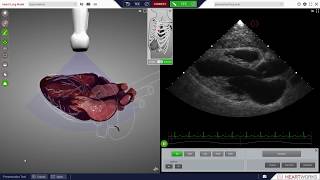 HeartWorks Hypovolemia [upl. by Anaoy]