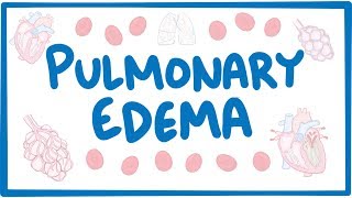 Pulmonary Edema  causes symptoms diagnosis treatment pathology [upl. by Raab]