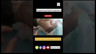 Diagnose Hydrocephalus [upl. by Grizelda766]