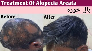 Treatment Of Alopecia Areata [upl. by Eitra]