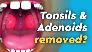 Tonsils and Adenoids Surgery [upl. by Deibel]