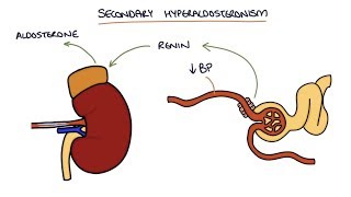 Hyperaldosteronism and Conns Syndrome [upl. by Latihs]