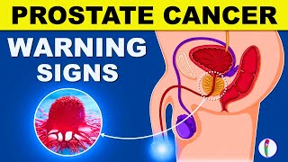 Early Prostate Cancer Symptoms You Must Not Ignore  Doctor Television [upl. by Julissa]