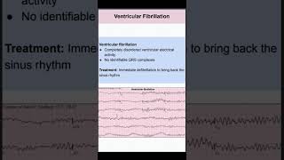 Ventricular Fibrillation [upl. by Spearman]