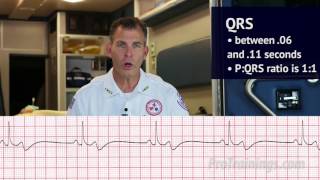 Bradycardia ECG Rhythm Interpretation [upl. by Belvia]