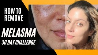 Melasma Removal at Home I Melasma Remove cream I Melasma Skin Care Regimen Routine [upl. by Llennol]