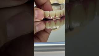 Outstanding option for full mouth implant zirconia [upl. by Arracahs]