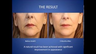 Artefill or Bellafill Facial Filler Before and After [upl. by Yelhak]