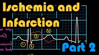 Ischemia Infarction and the Waveforms Q through U Part 2 How to Read an EKG Curriculum [upl. by Berkly]