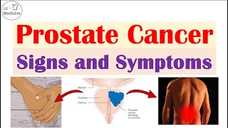 Prostate Cancer Signs and Symptoms Urinary Sexual amp Metastatic Symptoms [upl. by Herculie585]