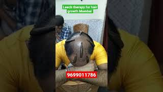 Leech therapy for hair growth Mumbai kzhijama shorts reels viral leechtherapy [upl. by Esila]