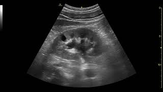 PoCUS Kidney and Bladder Ultrasound [upl. by Teresita]