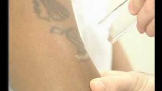 Laser Tattoo Removal on Dark Skin with the MedLite [upl. by Ai]