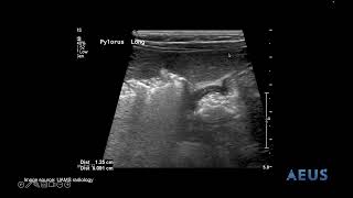 Pyloric Stenosis NLS Video [upl. by Ahsirahc969]