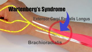 Wartenbergs Syndrome [upl. by Oliana]