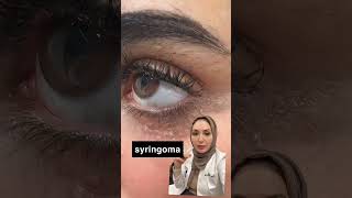 Syringomaجلديةدفاتنبخار ديرموركلينك dermoreclinic drfatenbukhari ليزر بشرة جلدية laser [upl. by Neibaf249]