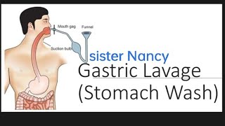 Gastric lavage  stomach wash [upl. by Rizzi760]